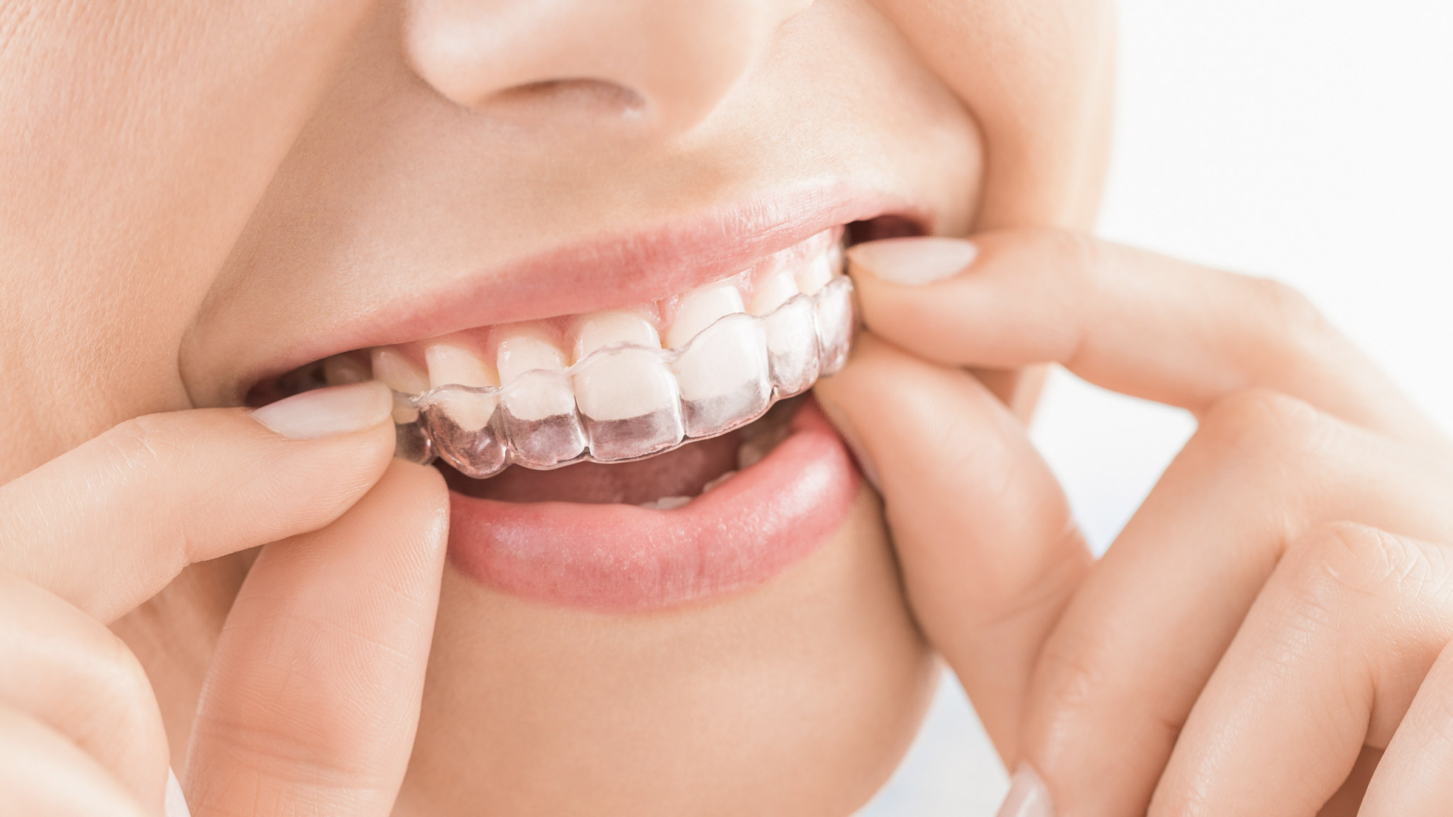 tratamento com invisalign em porto alegre