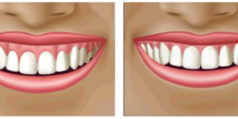 antes-depois-sorriso-gengival-tratamento-1